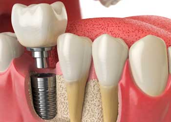 Implante dentário grátis pelo SUS