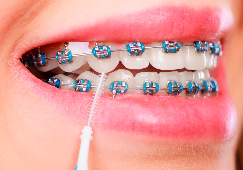Veja como conseguir aparelhos dentário grátis pelo SUS